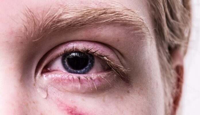 5 Jenis Penyakit Mata: Gejala, Penyebab, dan Cara Mengobatinya!