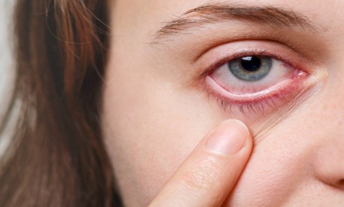 Penyakit Mata Konjungtivitis